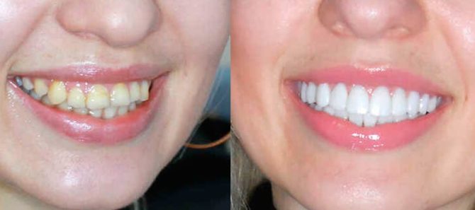 Zuby pred a po inštalácii dyhy
