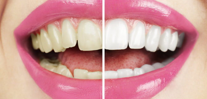 Dents après blanchiment