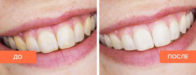 Dents après blanchiment avec de la soude et du peroxyde