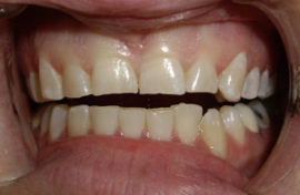 Bruxism teeth