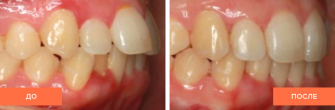 I denti del bambino prima e dopo l'applicazione del cappuccio