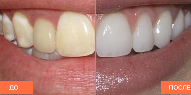 שיניים עם פלואורוזיס לפני הלבנה ואחריה
