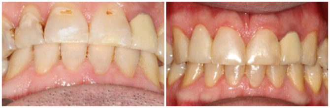 Gigi dengan karies asas yang cetek sebelum dan selepas rawatan