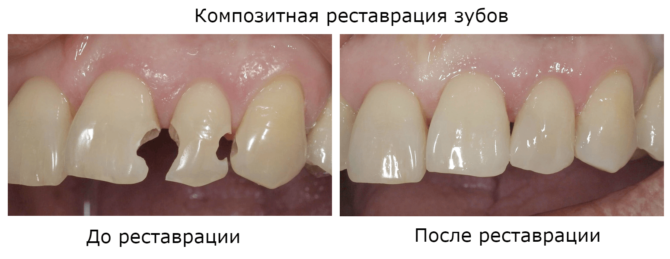 Gigi dengan cip sebelum dan selepas pemulihan komposit