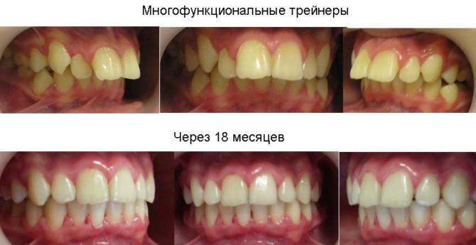 Zuby dospelého pacienta pred a po aplikácii trénerov