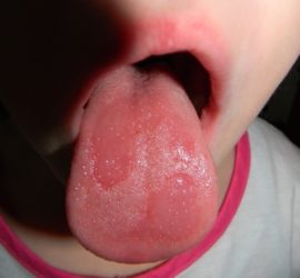 Allergic glossitis of the tongue