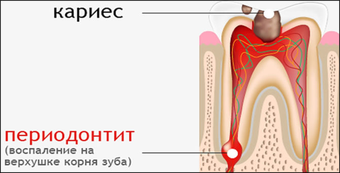 Kas yra periodontitas?