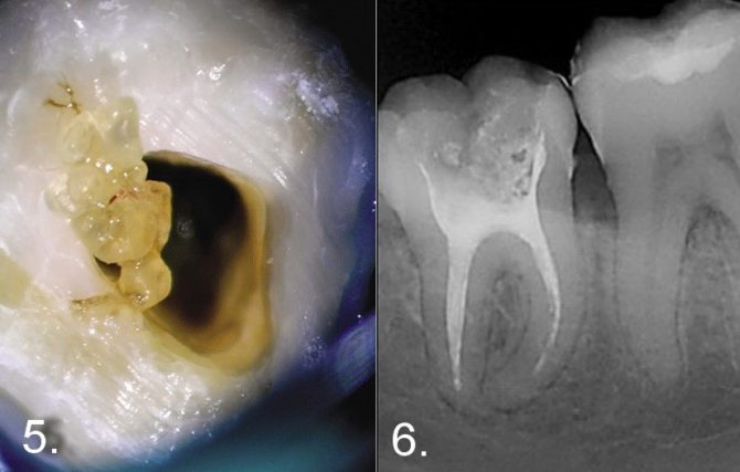 Denticule în pulpă pe radiografie