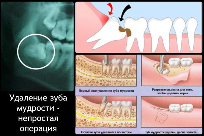 Sudėtingo išminties danties ištraukimo etapai