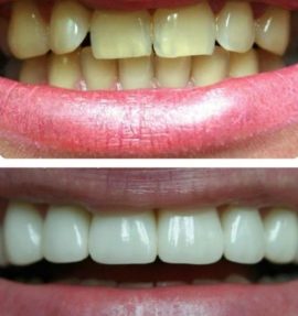 Foto de los dientes antes y después de instalar la carilla.