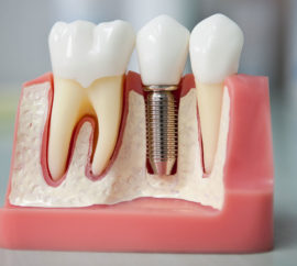 Zubní implantace