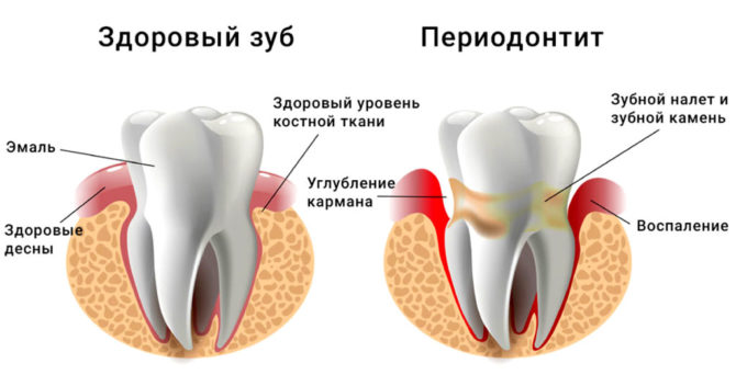 What periodontitis and a healthy tooth look like