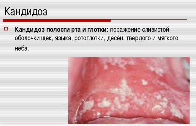 Candidiasis in the mouth