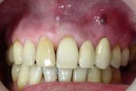 Cyst on the gum