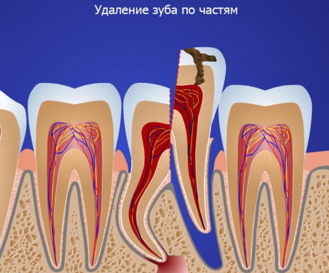 Laserová extrakce zubu moudrosti v částech