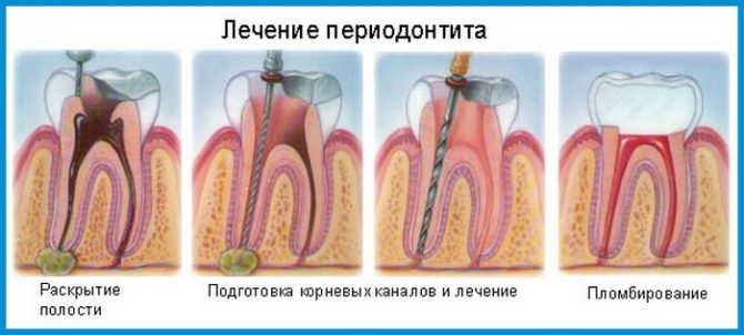Trattamento parodontite