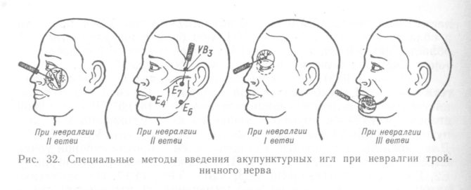 Metode uvođenja akupunkturnih igala za trigeminalnu neuralgiju