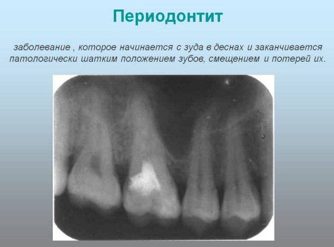 Parodontite aux rayons X