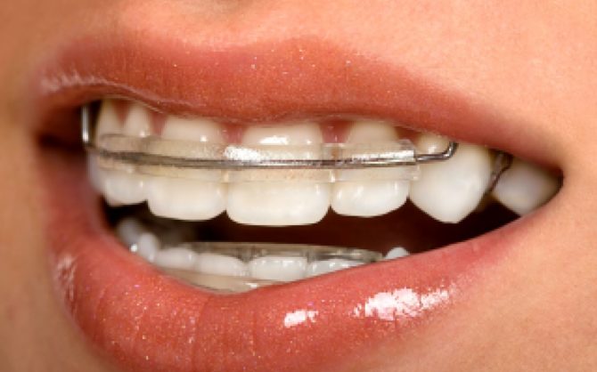 Placas de alineación de dientes