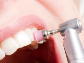 Dantų poliravimas pašalinus rauginius raiščius