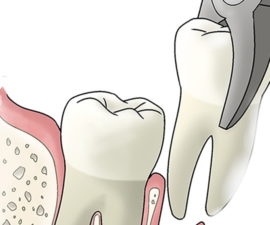 Simple wisdom tooth extraction