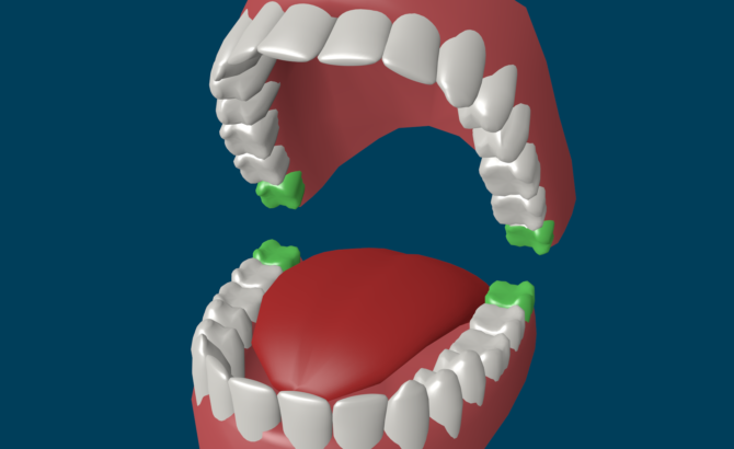 La posizione del dente del giudizio nella dentatura