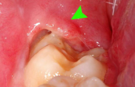Disposition des dents de sagesse dans la poche gingivale