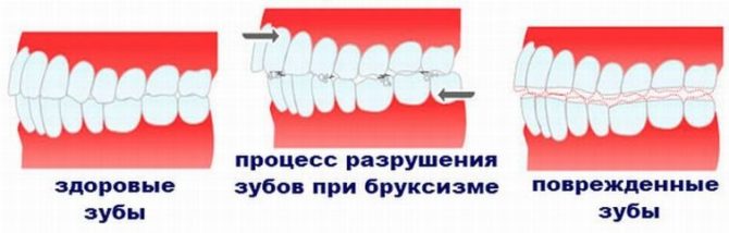Tooth decay with bruxism