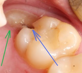 Wisdom tooth retention