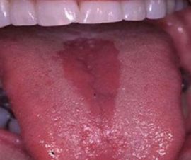 Glositis de lengua en forma de diamante