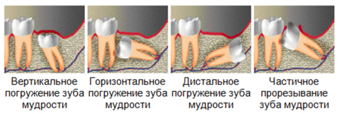 צמיחת שיני בינה עם דיסטופיה
