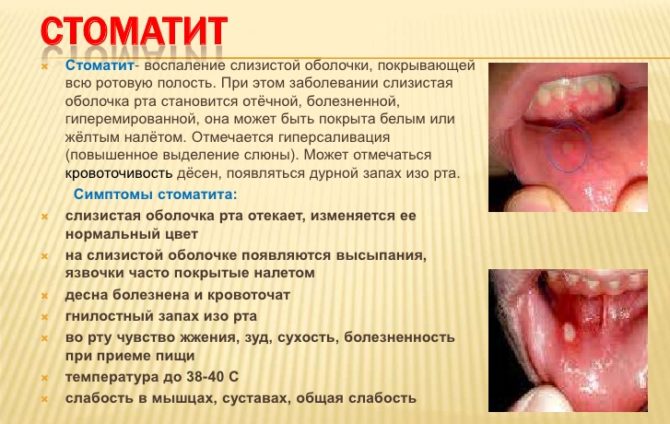 Symptoms of stomatitis