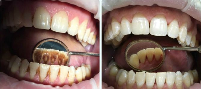 Ini adalah bagaimana gigi kelihatan sebelum dan selepas penyingkiran tartar