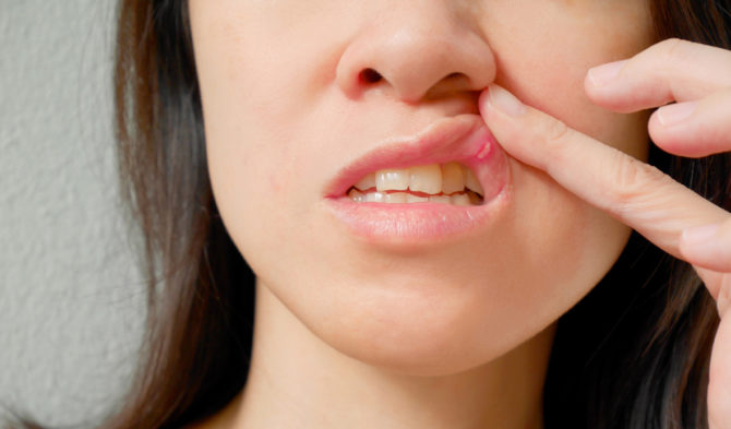 Una mujer tiene estomatitis en la boca.