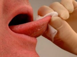 Fjerne plakett fra tungen