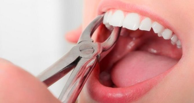 Operácia extrakcie zubov