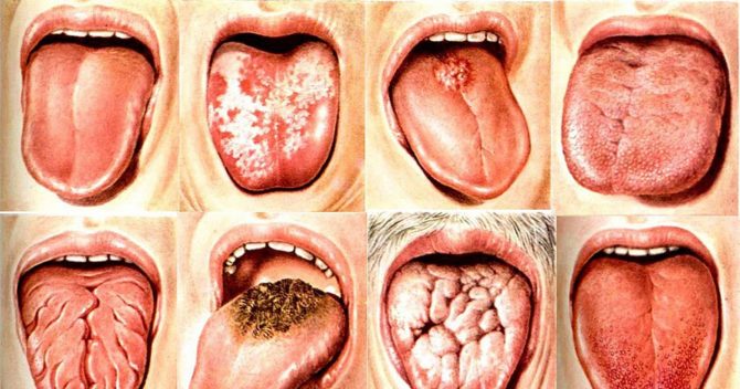 Typer av glossit i tungan