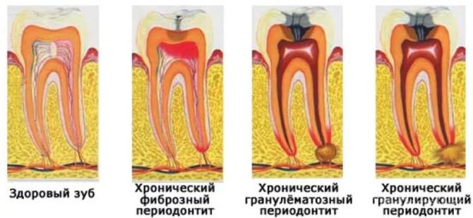 Types and manifestations of periodontitis