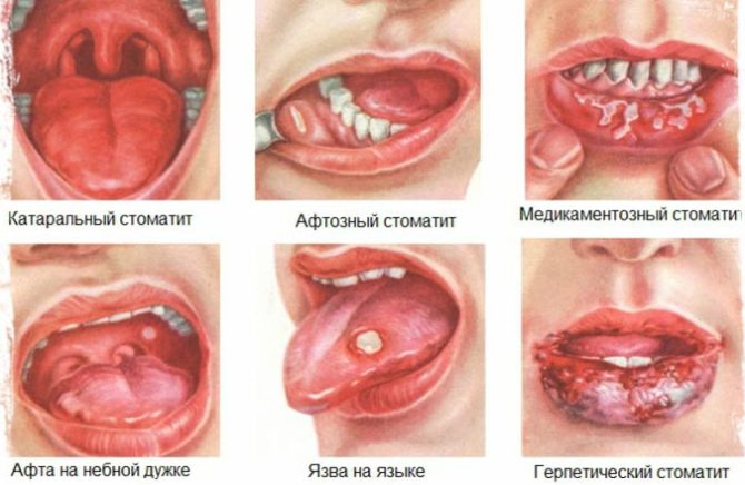 أنواع التهاب الفم