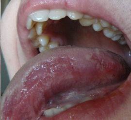 Yttre tecken på glossit i tungan