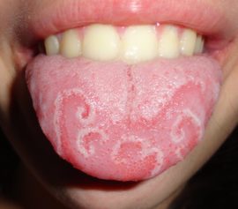 External signs of glossitis of the tongue