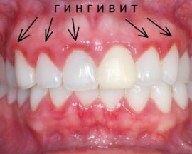 Externa manifestationer av tandköttsinflammation
