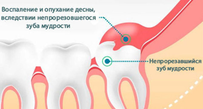 Inflammation and swelling of the gums due to an unbreakable wisdom tooth