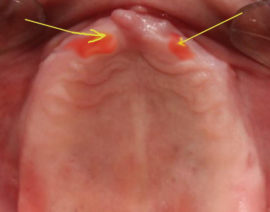 Prótesis de la mucosa oral.