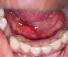 Inflamación de la glándula salival debajo de la lengua.