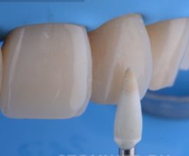 Restauration dentaire avec placage composite