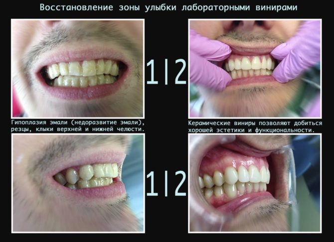 Restauration des dents avec des facettes