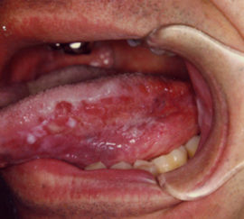Ulcerative glossitis of the tongue