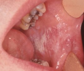 Sores with necrotic form of gingivitis