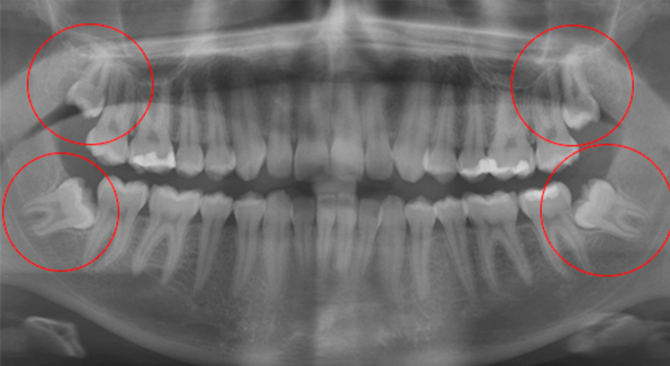 Ortopantomogram zuba mudrosti